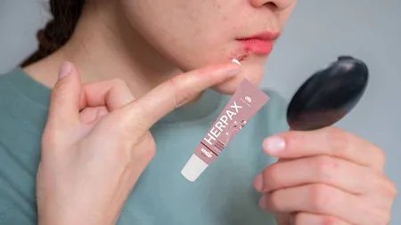 Herpel labiale usa Herpax