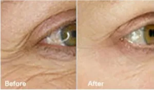 eyelift