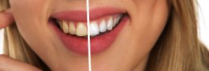 Come avere denti bianchi naturalmente