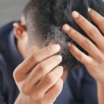 alopecia e integratori